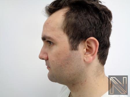 Laser Skin Resurfacing - Face: Patient 3 - Before 4