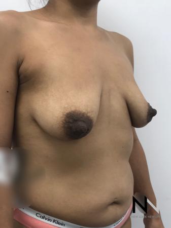 Breast Lift: Patient 1 - Before Image 2