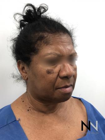 Facelift/Mini Facelift: Patient 7 - Before and After Image 4
