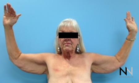 Brachioplasty: Patient 9 - Before Image 1