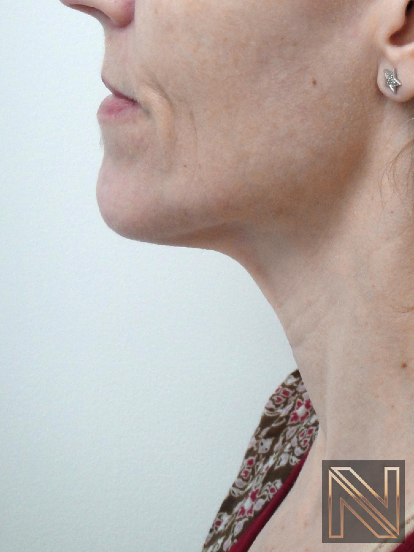 Ultherapy®: Patient 1 - After 1