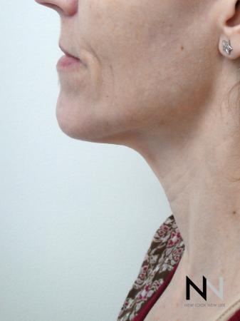 Ultherapy®: Patient 1 - After 1