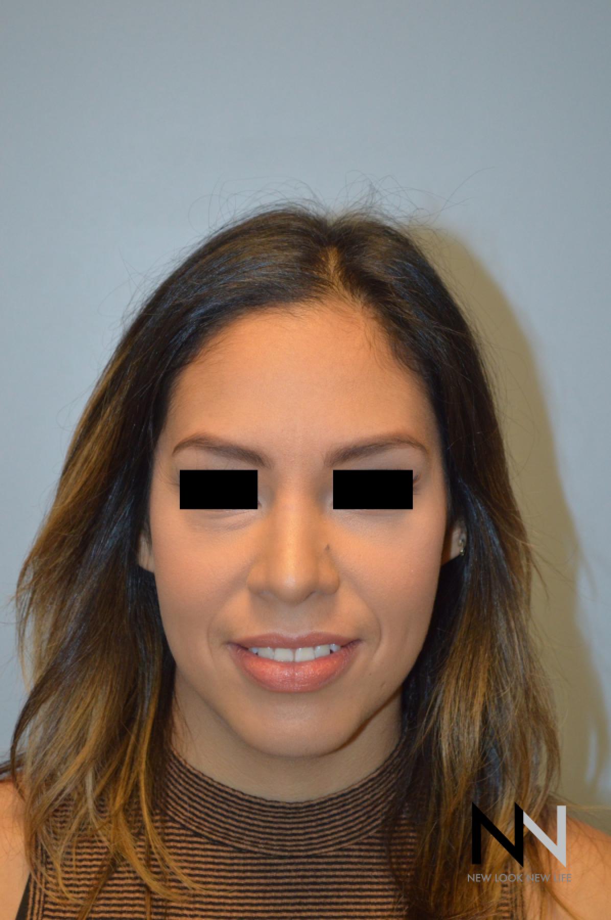 Rhinoplasty: Patient 6 - After  