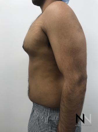 Gynecomastia: Patient 7 - Before Image 2