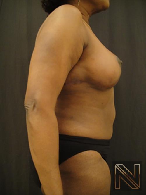 Breast Reduction: Patient 4 - After 5