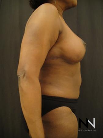Breast Reduction: Patient 4 - After Image 5