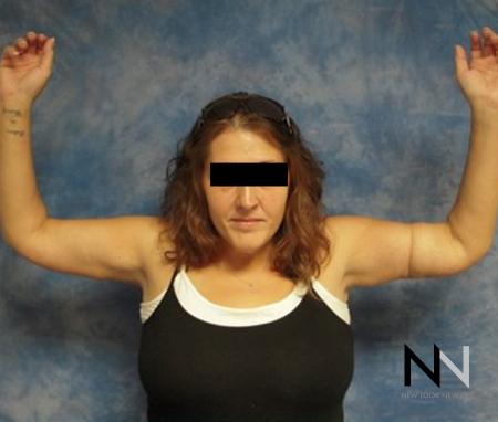 Brachioplasty: Patient 7 - After Image 1