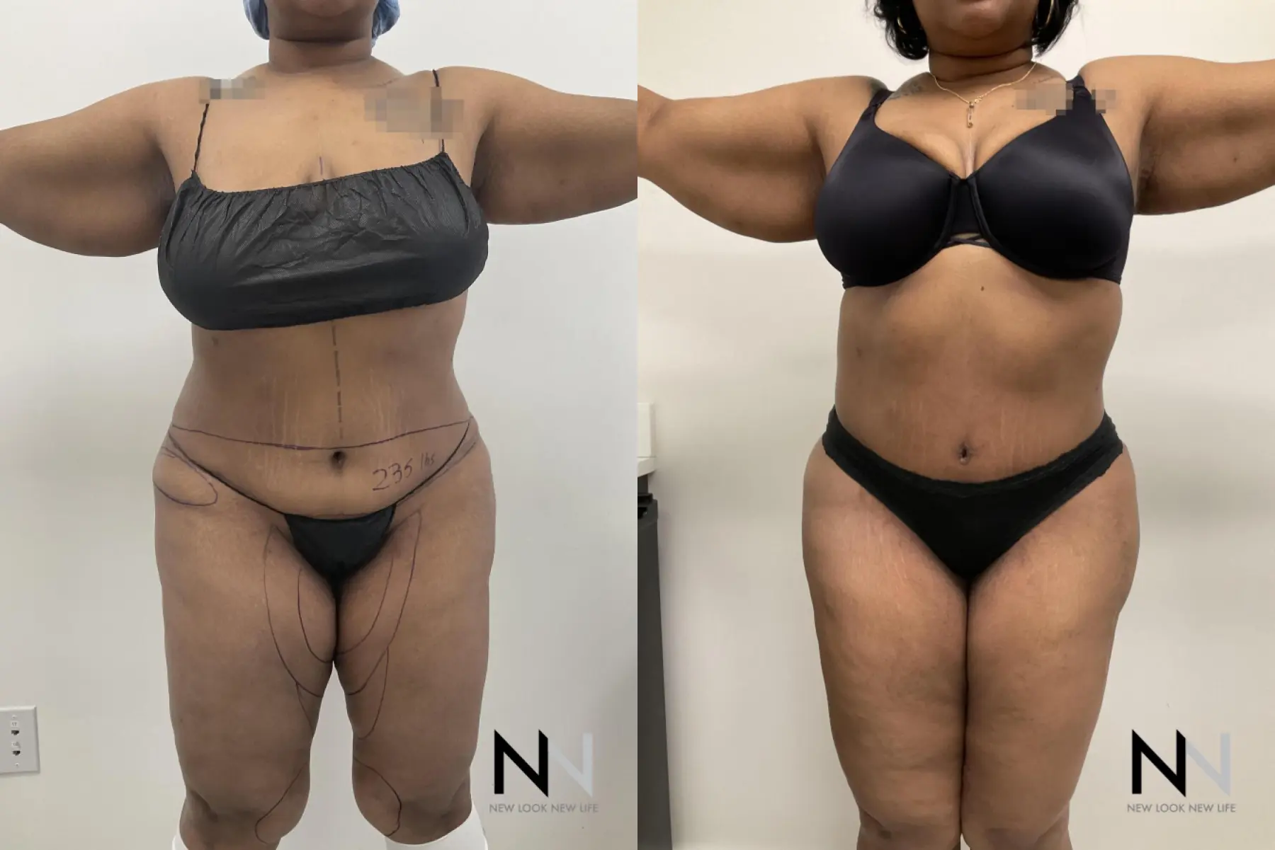 Brazilian Butt Lift: Patient 14 - Before and After  