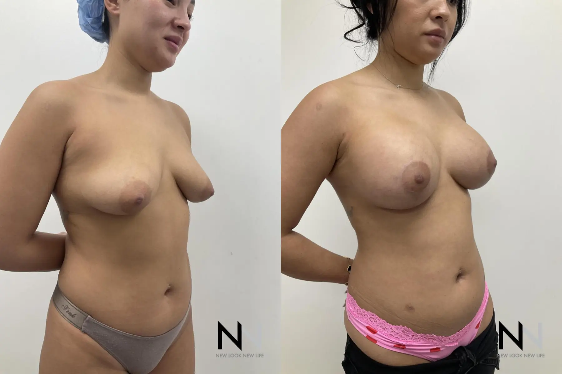 Breast Augmentation: Patient 26 - Before and After 5