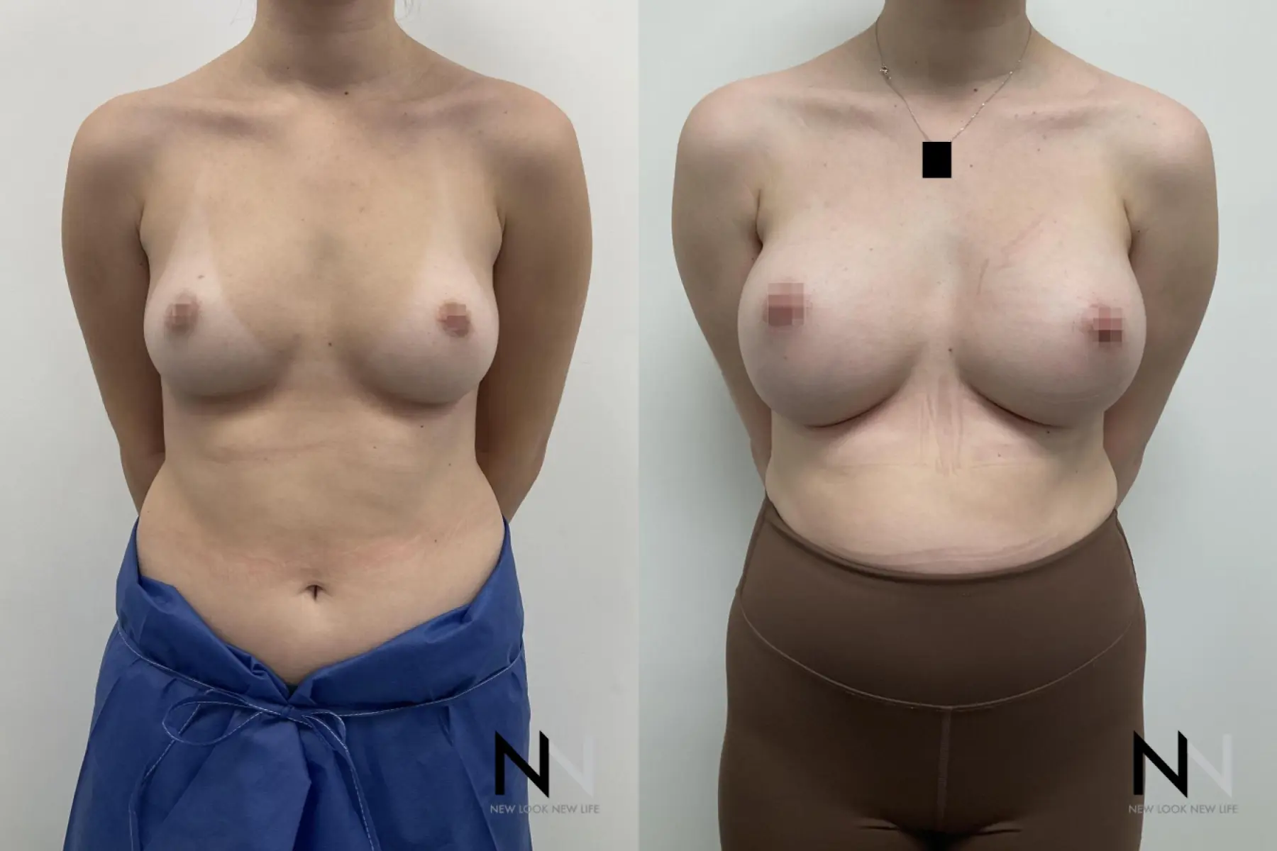 Breast Augmentation: Patient 20 - Before and After  