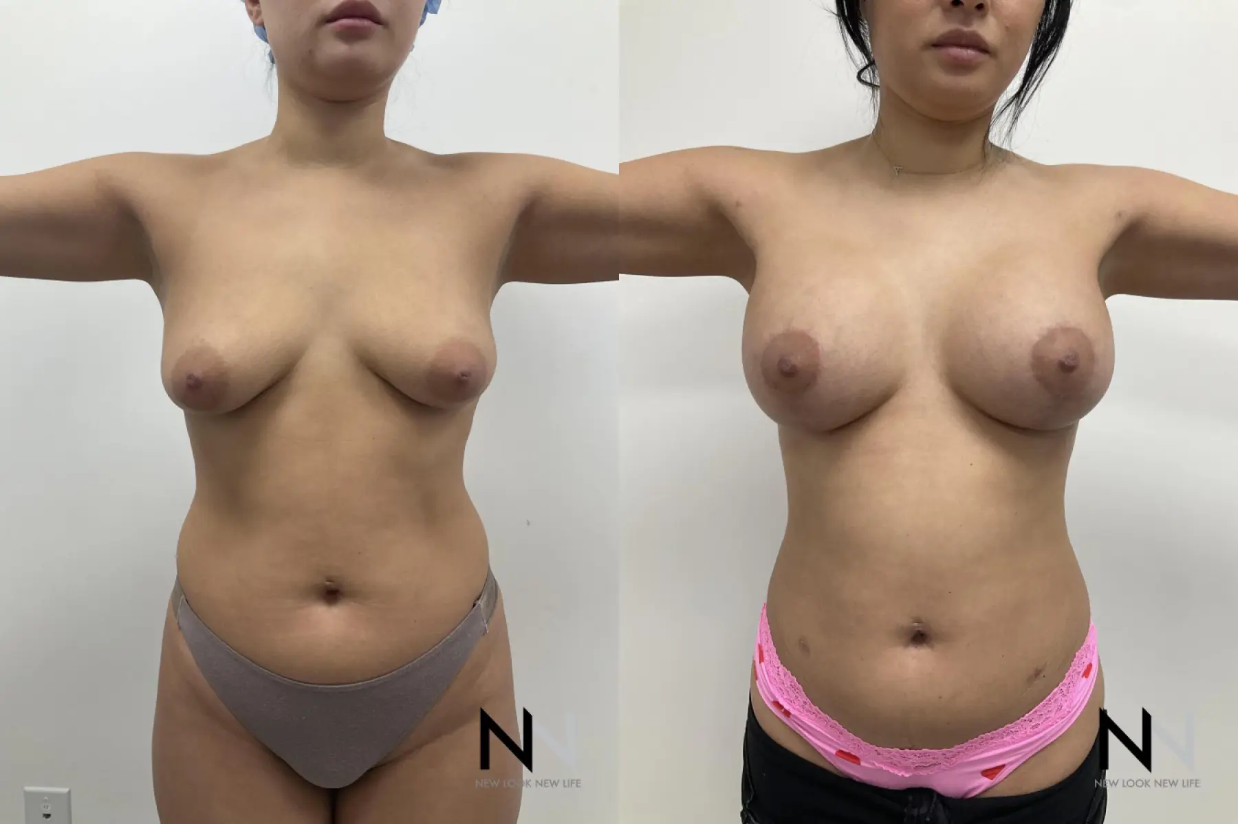 Breast Augmentation: Patient 26 - Before and After 2