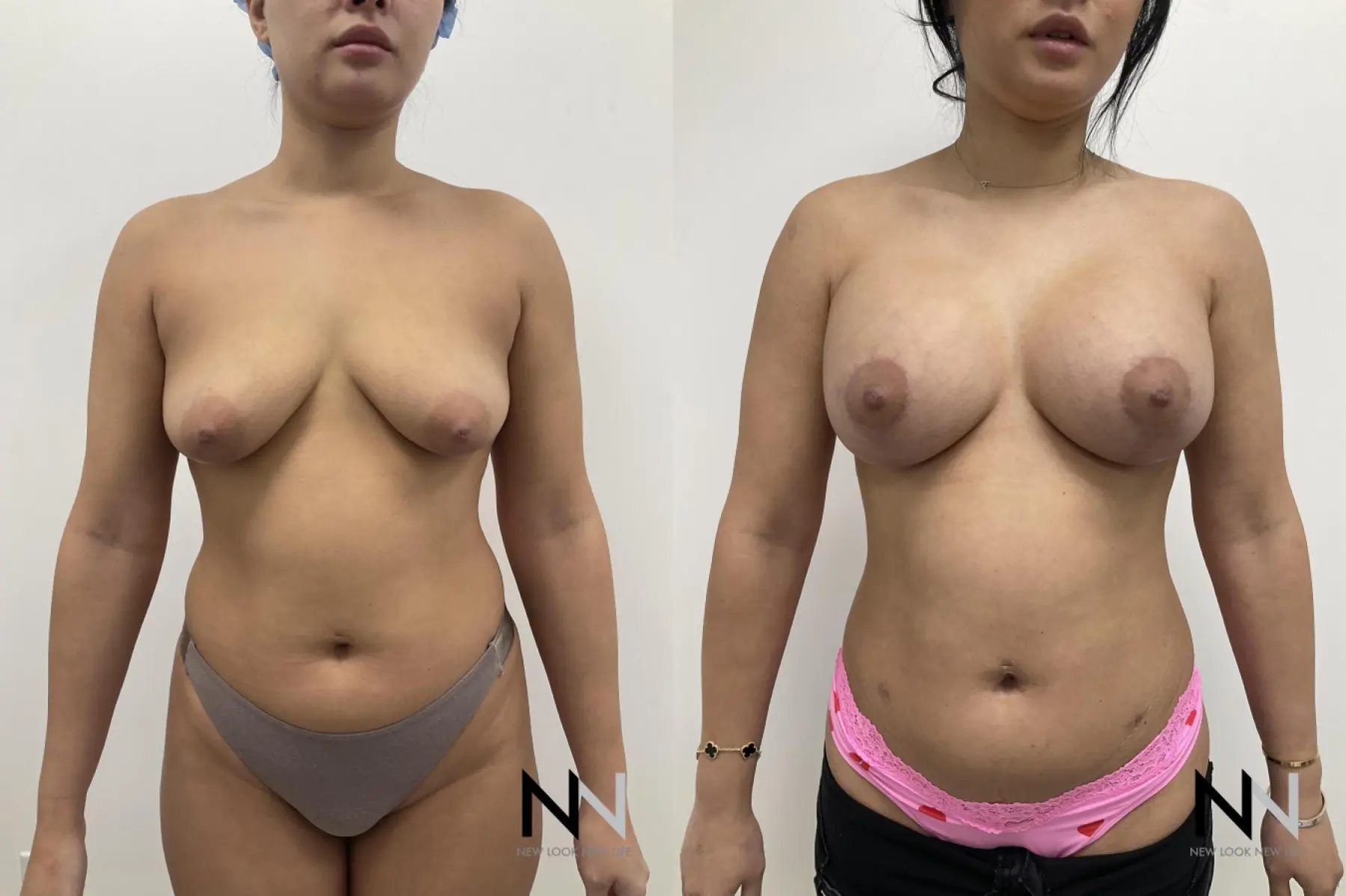 Breast Augmentation: Patient 26 - Before and After  