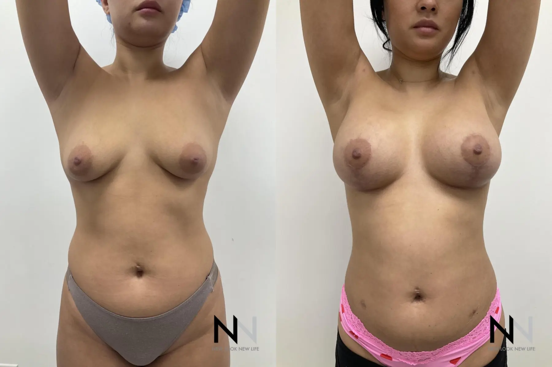 Breast Augmentation: Patient 26 - Before and After 7