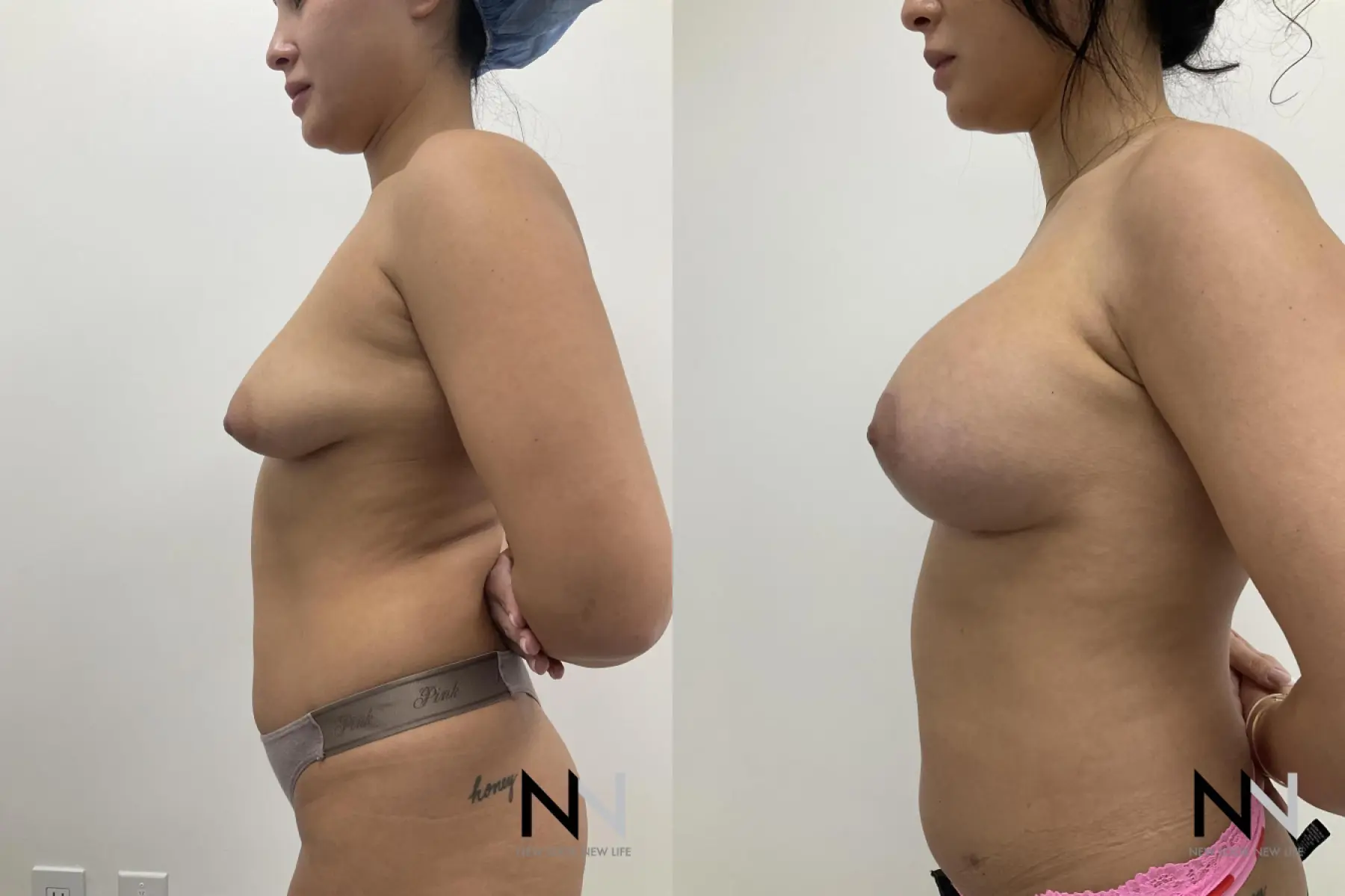 Breast Augmentation: Patient 26 - Before and After 4