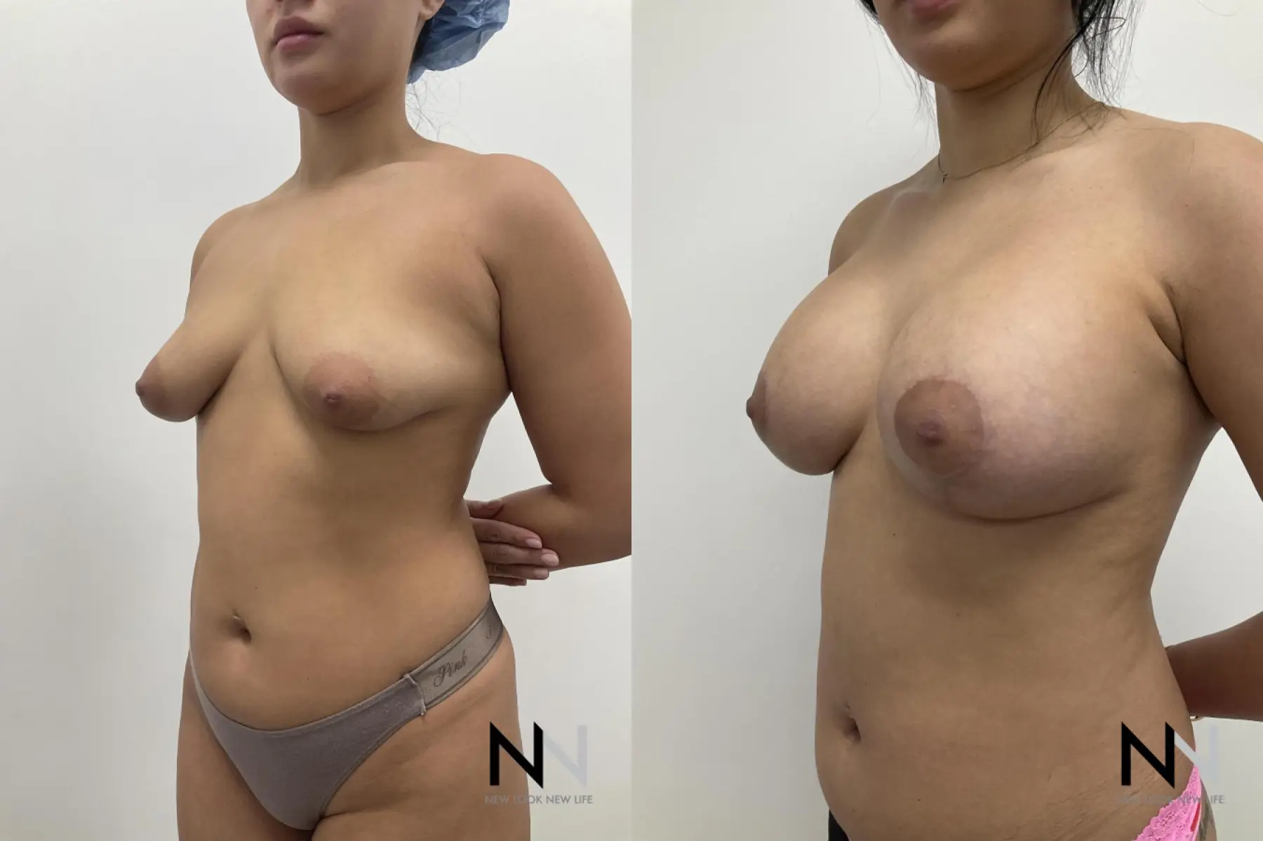 Breast Augmentation: Patient 26 - Before and After 3