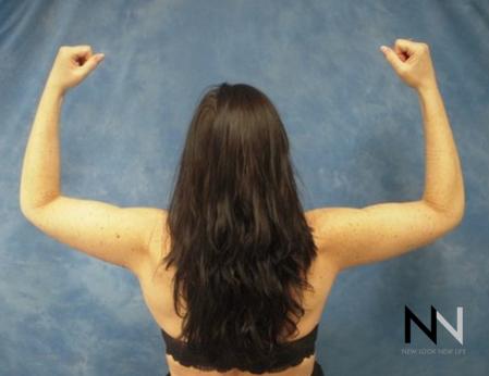 Brachioplasty: Patient 2 - After Image 2
