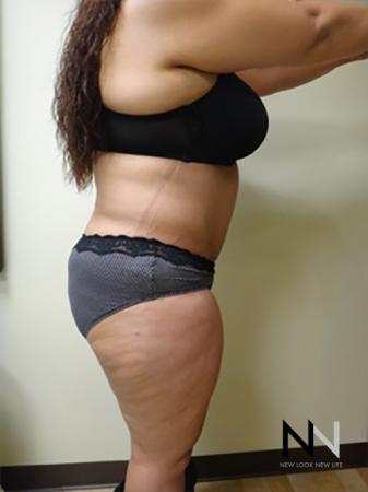 Abdominoplasty: Patient 11 - After Image 3