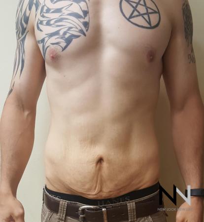 Mini Tummy Tuck: Patient 2 - Before Image 1