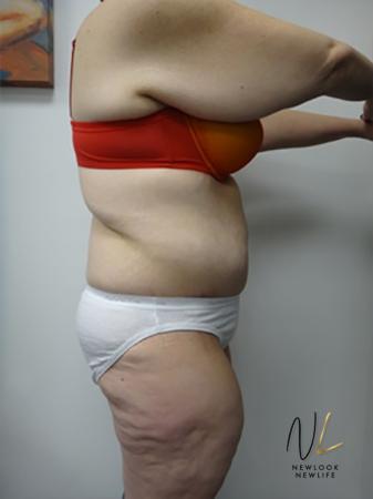 Abdominoplasty: Patient 12 - After 3