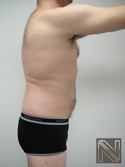 Liposuction: Patient 17 - After 2