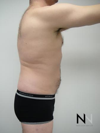 Liposuction: Patient 17 - After Image 2