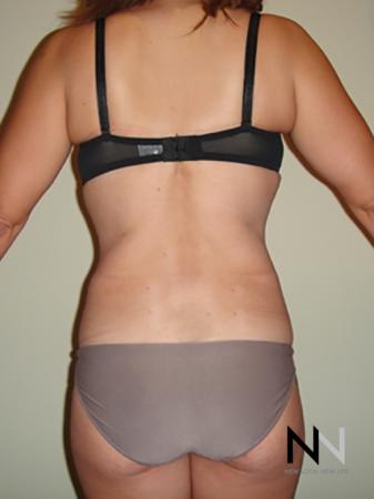 Liposuction: Patient 7 - After Image 4