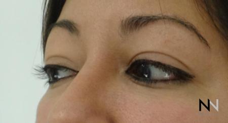 Fillers: Patient 10 - After 1