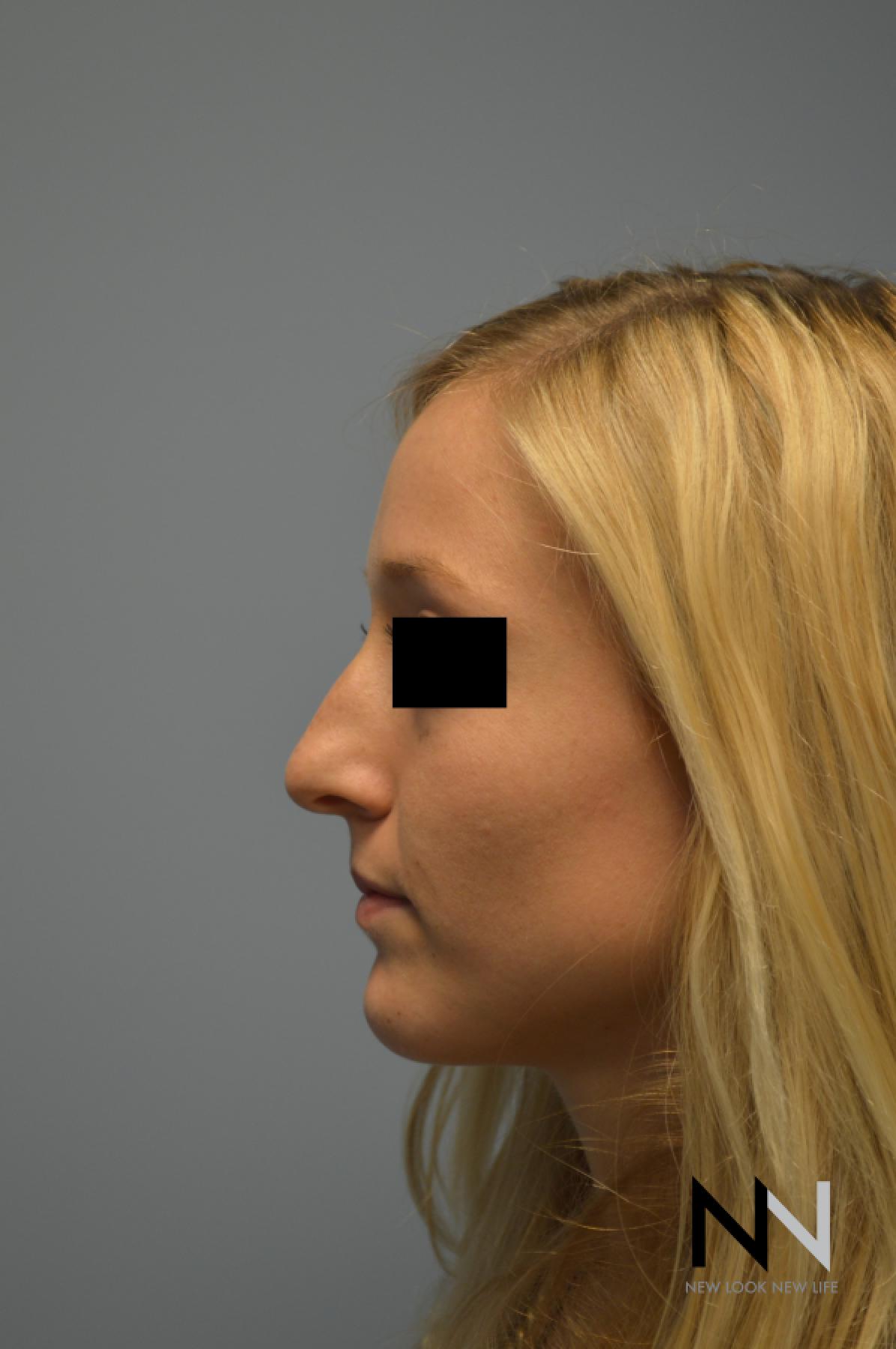 Rhinoplasty: Patient 1 - Before 1