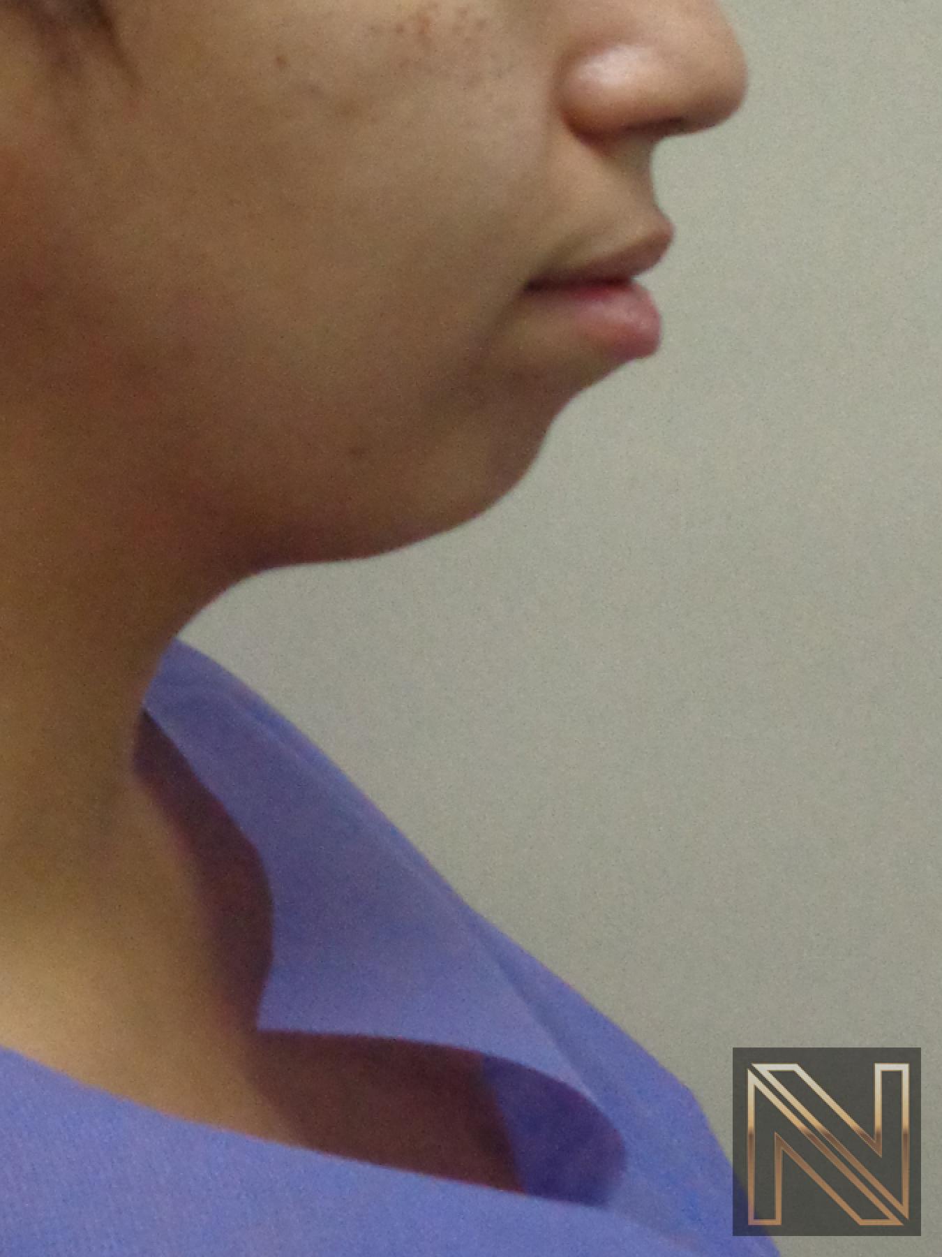 Chin Augmentation: Patient 1 - Before 1