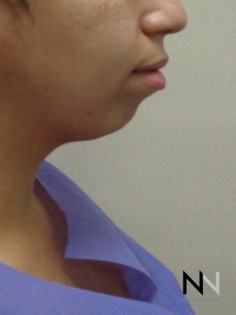 Chin Augmentation: Patient 1 - Before Image 1