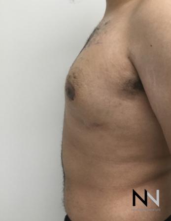 Gynecomastia: Patient 10 - After Image 2