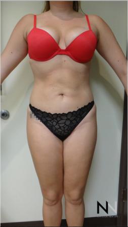 Butt Augmentation: Patient 3 - After Image 1