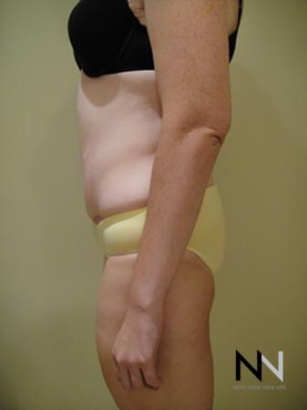 Abdominoplasty: Patient 2 - After Image 2