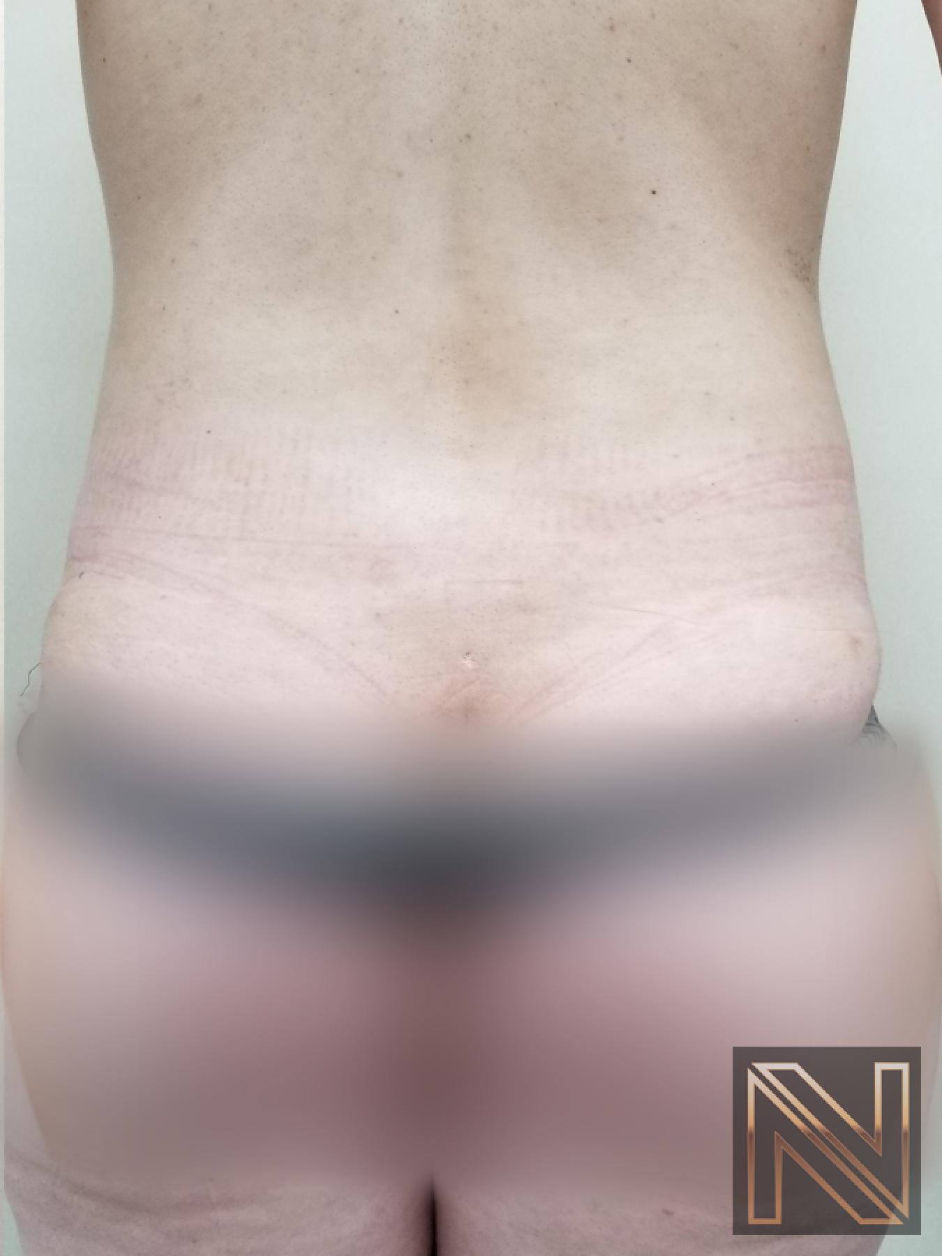 Liposuction: Patient 22 - After 1