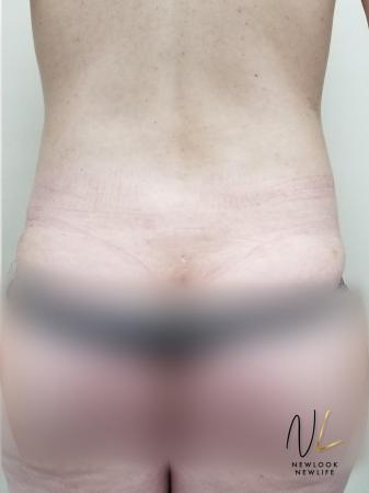 Liposuction: Patient 22 - After Image 1