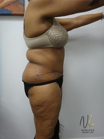 Abdominoplasty: Patient 8 - After Image 3