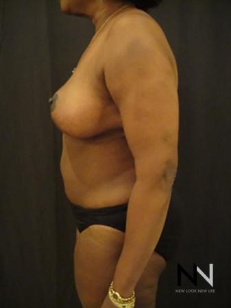 Breast Reduction: Patient 4 - After Image 4