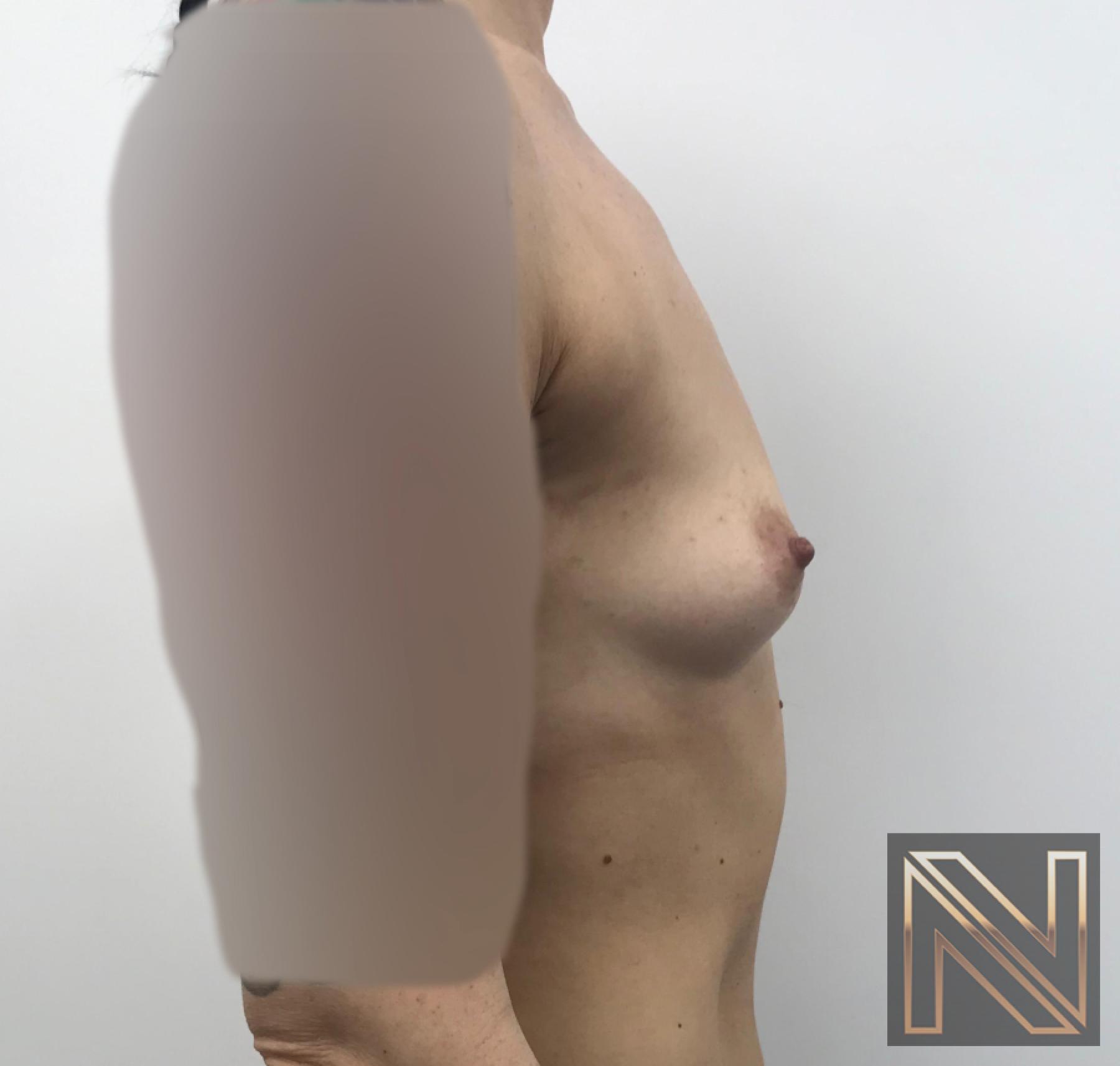 Breast Augmentation: Patient 2 - Before and After 3