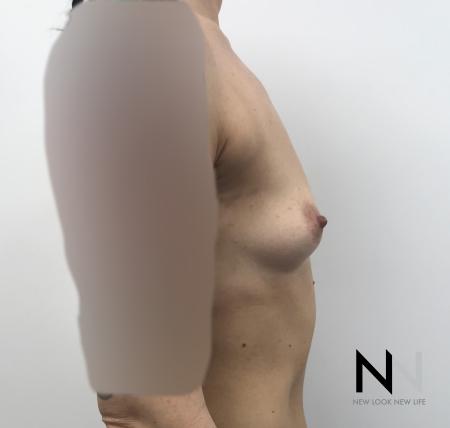 Breast Augmentation: Patient 2 - Before and After Image 3