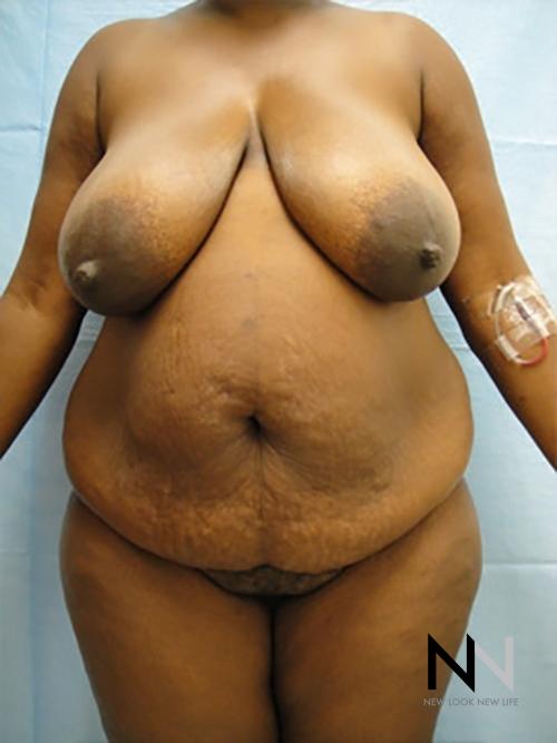 Abdominoplasty: Patient 9 - Before 