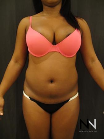 Liposuction: Patient 4 - Before Image 1