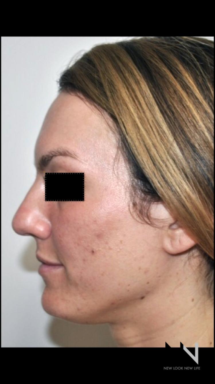 Rhinoplasty: Patient 2 - Before 