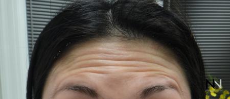 Dysport® : Patient 6 - Before Image 1