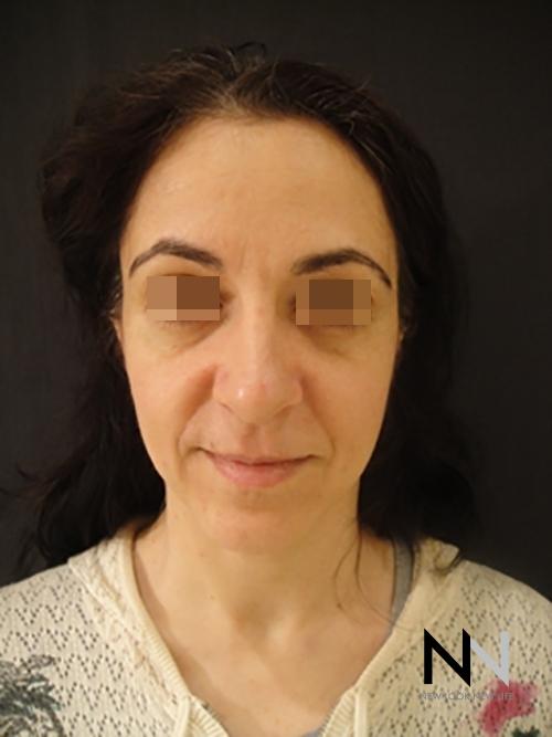 Liquid Facelift: Patient 1 - Before 1