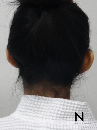 Otoplasty And Earlobe Repair: Patient 6 - Before Image 1