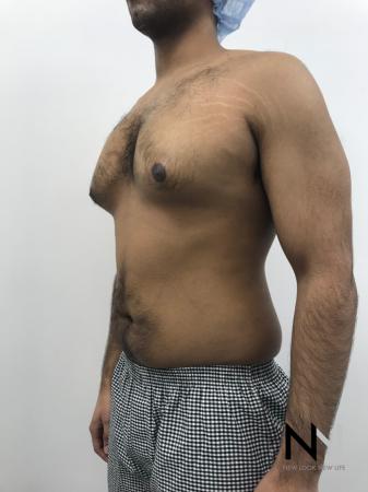 Gynecomastia: Patient 7 - Before Image 3