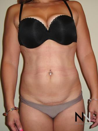 Liposuction: Patient 7 - After Image 1
