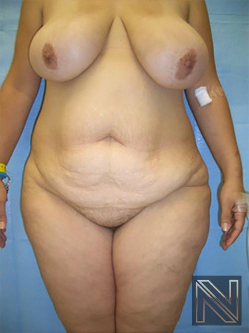 Abdominoplasty: Patient 19 - Before 1