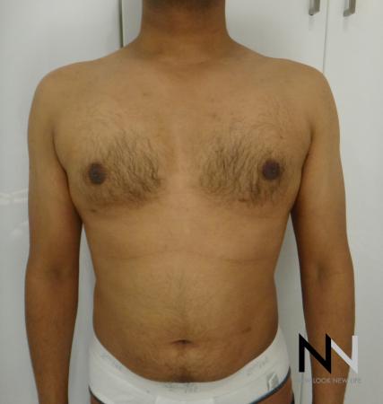 Gynecomastia: Patient 6 - After Image 1