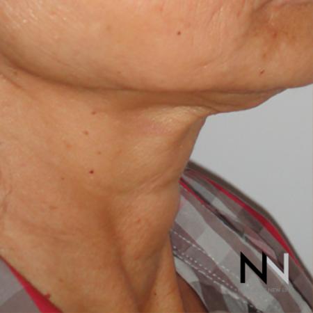 SkinTyte II™: Patient 2 - After Image 1